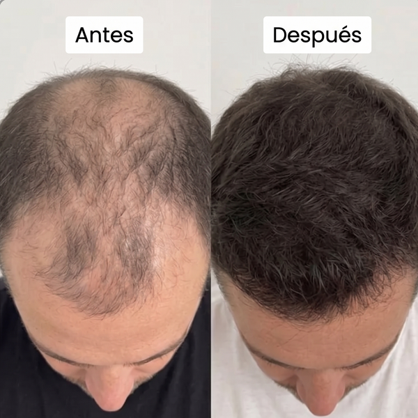 Resultado Antes y Después